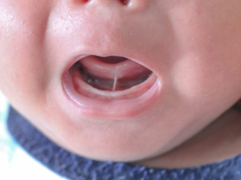 Tongue-tie in babies