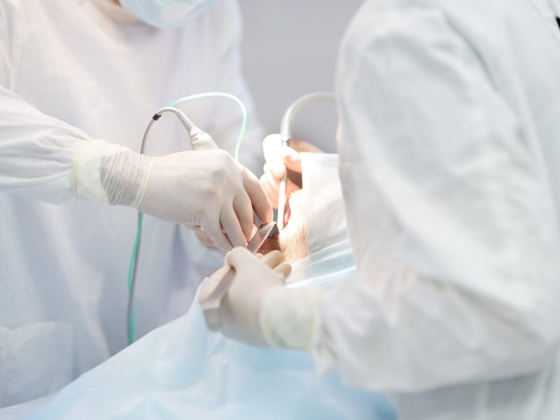 Wisdom Tooth Extraction Under General Anaesthesia