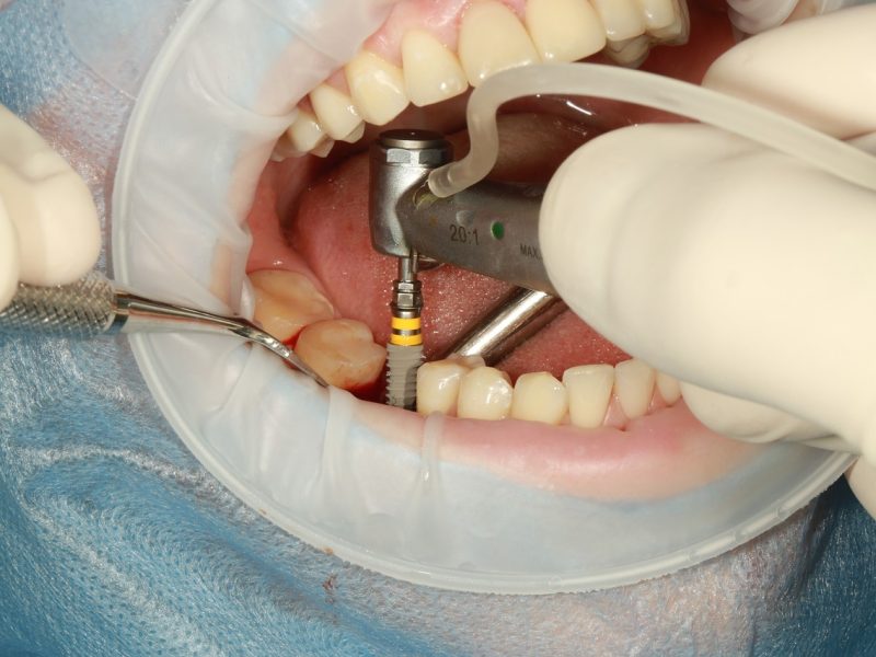 dental implants under iv sedation