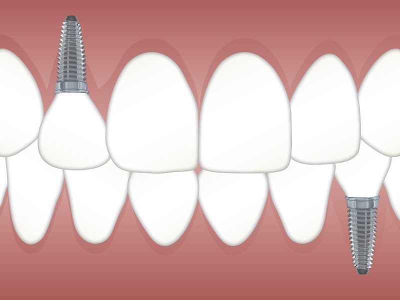 Long-Term Solution for Tooth Replacement