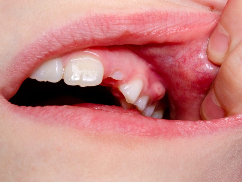 dental abscess