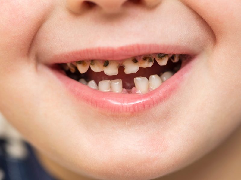 untreated cavities in baby teeth