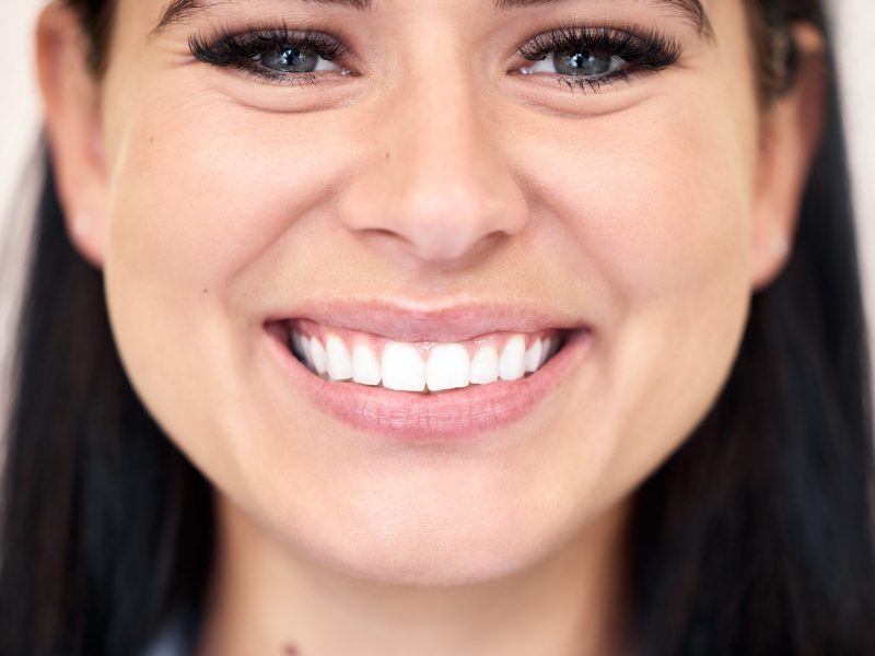 Smile makeover treatments